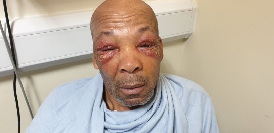 Bilateral preseptal cellulitis secondary to herpetic eczema.