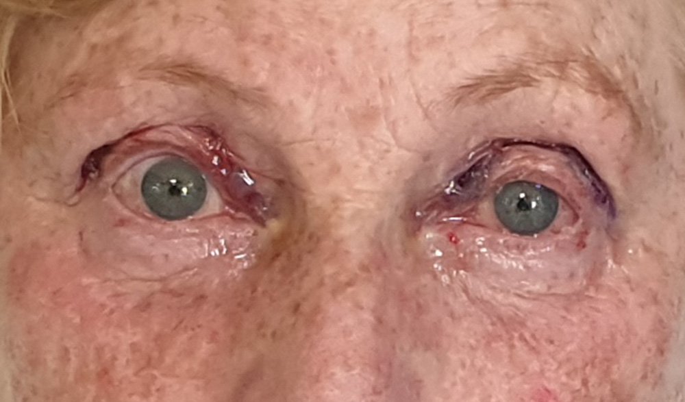 Ptosis - Thanos Bezatis