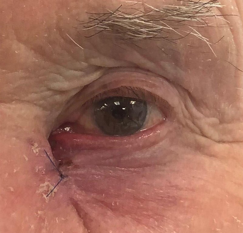 Eyelid lumps - Thanos Bezatis