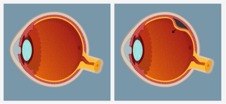 Retinal Detachment - Thanos Bezatis