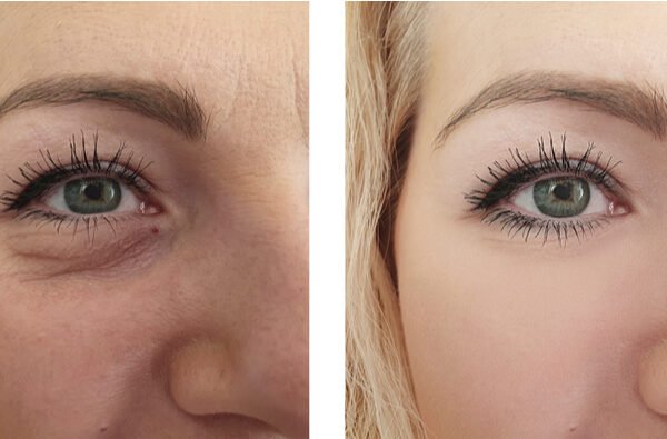 Η βλεφαροπλαστική είναι η επέμβαση της περιοχής των άνω ή/και κάτω βλεφάρων που αποσκοπεί σε λειτουργική και αισθητική βελτίωση του βλέμματος.