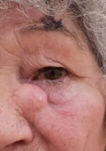 Όγκοι βλεφάρων