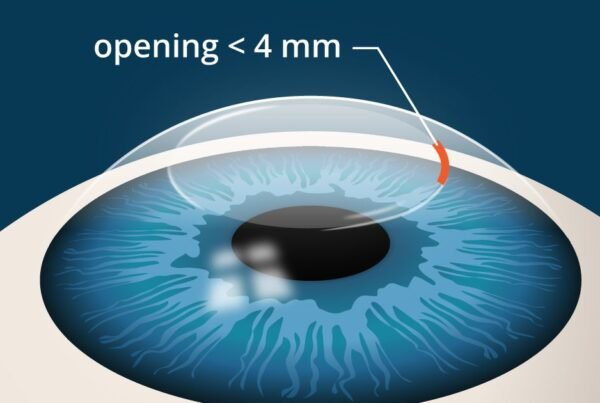 Λέιζερ στα μάτια: SMILE ή LASIK