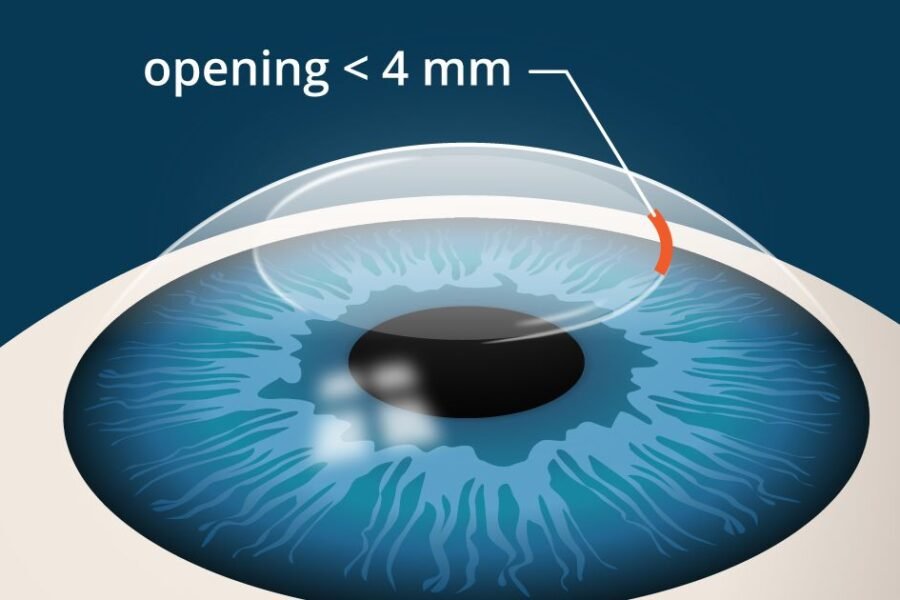 Λέιζερ στα μάτια: SMILE ή LASIK