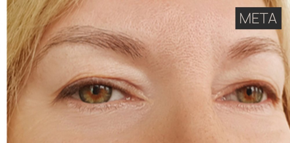 Βλεφαροπλαστική