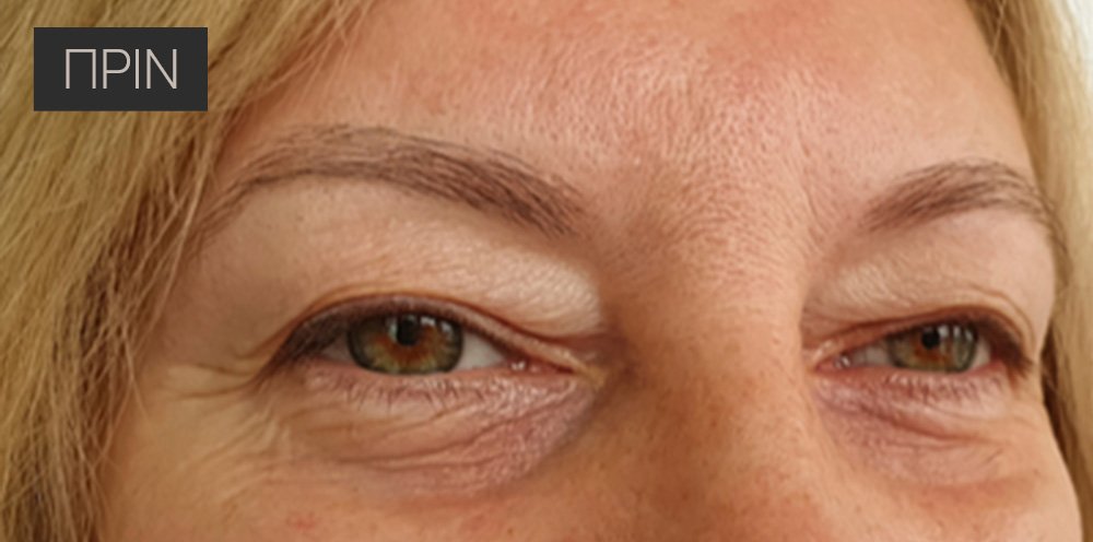 Βλεφαροπλαστική