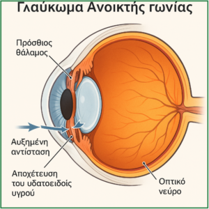 Χρόνιο γλαύκωμα ανοικτής γωνίας